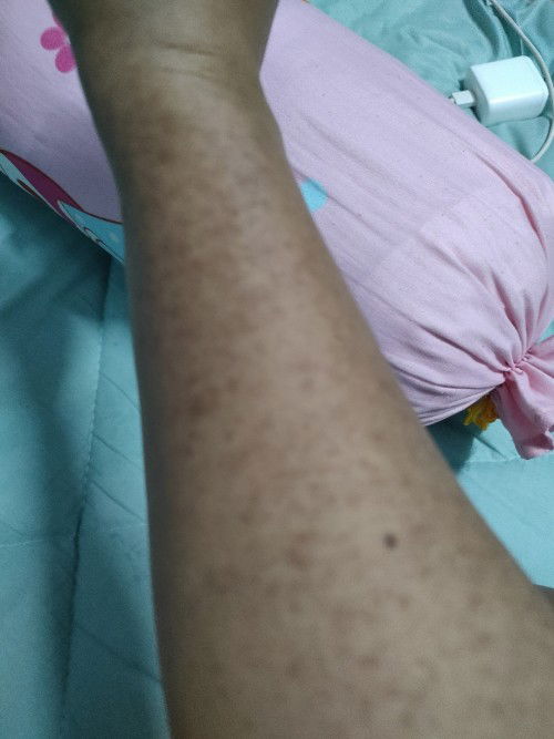 มีแม่ๆบ้านใหนเป็นบางค่ะโดนเจาะเลือดแล้วเป็นแบบนี้  เป็นเพราะสาเหตุไรค่ะ