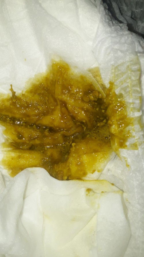 Bayi 2 bulan 10 hari fases hijau berlendir hingga 19 hari