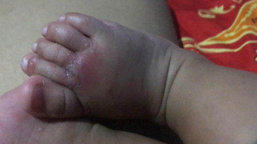 Kaki baby yg korengan