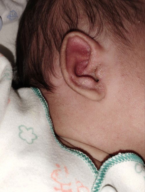 Apa pernah ada yang seperti ini kondisi telinga bayinya mom?