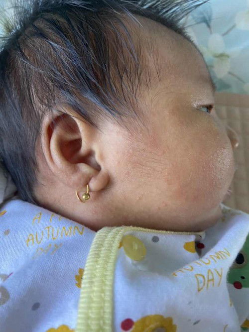 Biang keringet pada bayi