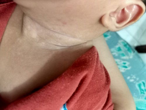 Bercak dileher seperti panu