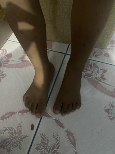 ลูกขาไม่เท่ากัน