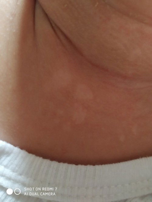 muncul totol putih di leher