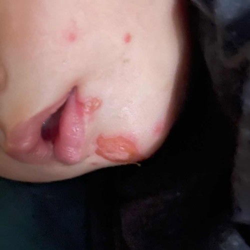 kulit seperti alergi