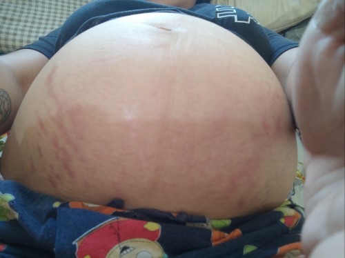 Stretch Marks