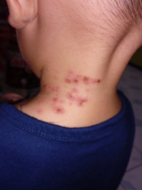 obat herpes anak 3th?