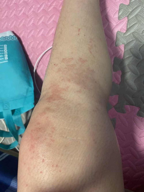 ผื่นคัน ยิ่งเกายิ่งคัน