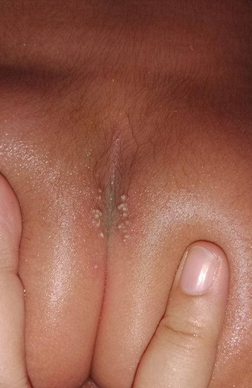 BINTIK RUAM DI PANTAT