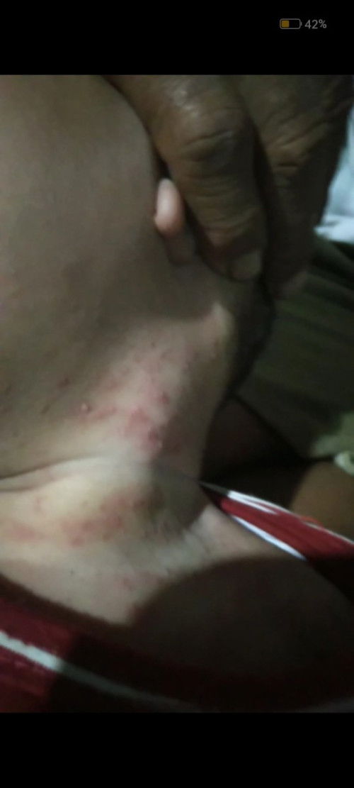 bintik merah dileher