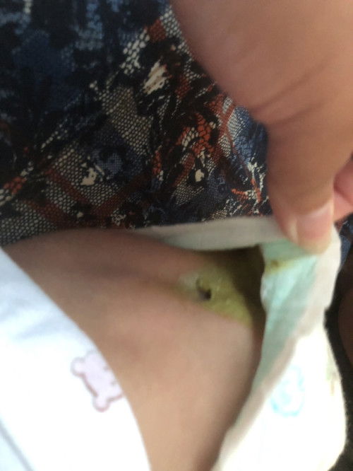 ขออนุญาตรูปถ่าย ลูกอึเป็นสีนี้ปกติมั๊ยค่ะ