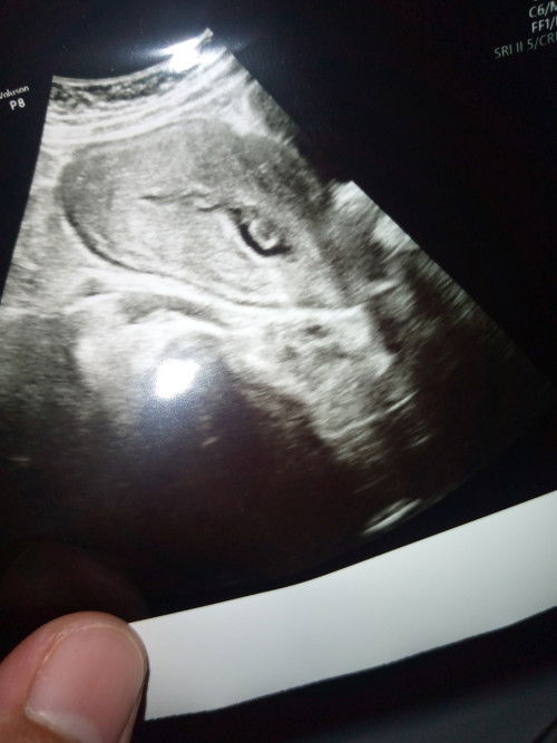 Sisa Ari2 masih ada didalam rahim