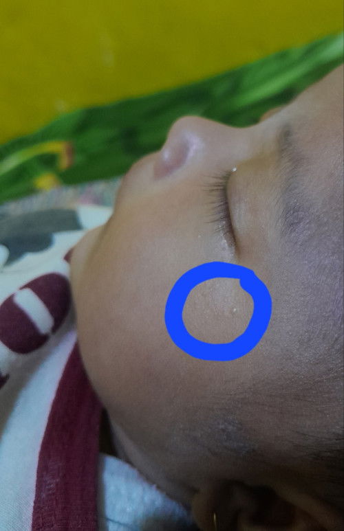 Bulat putih di wajah bayi
