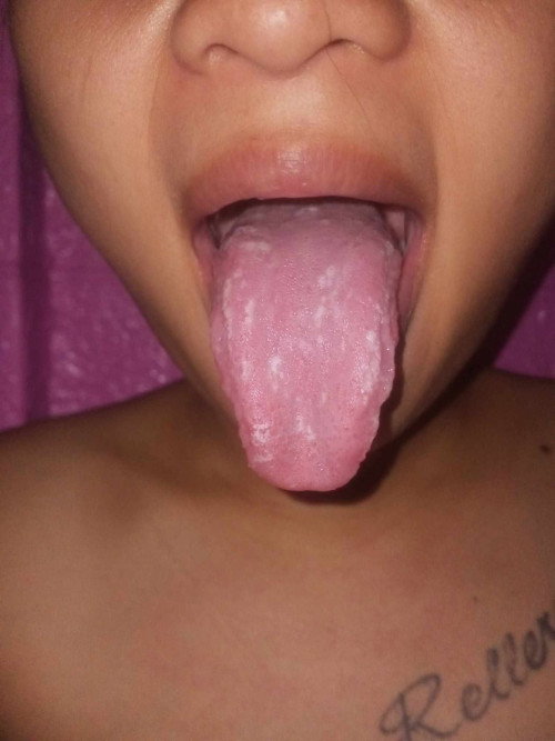 WHITE AND MAP IN TONGUE DURING PREGNANCY