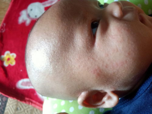 Saran obat/krim penghilang bintik merah/jamur pada bayi