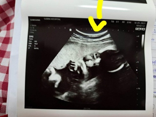 ลุ้นมากกับดั้งลูก