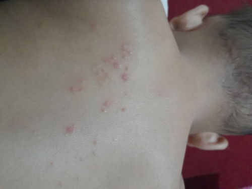 Beruntusan atau apa ya ini di punggung