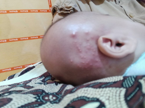 Gatal apa bisul ya Bun