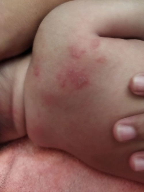 punggung bayi tbtb merah