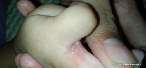 Ruam pada sela-sela jari