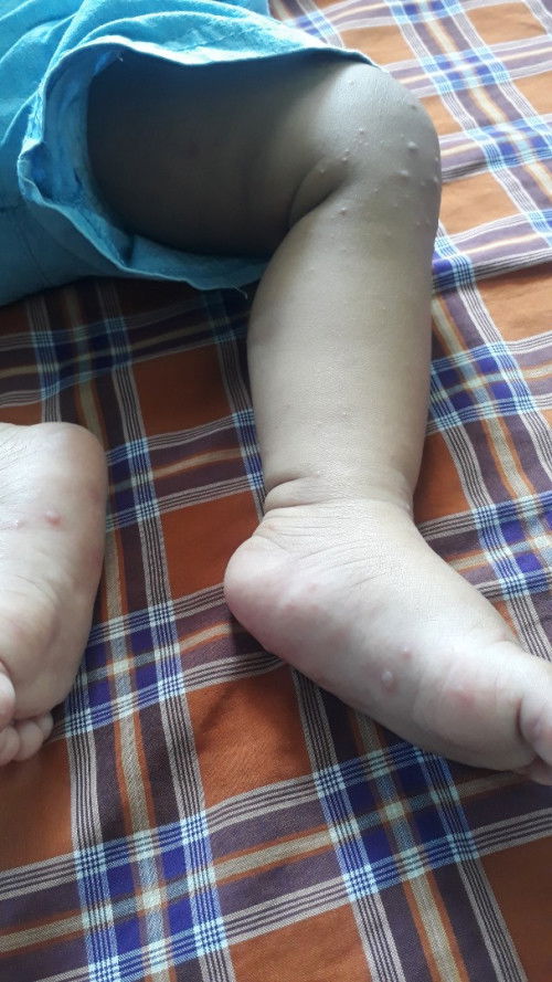 Masalah kulit bayi 11 bulan