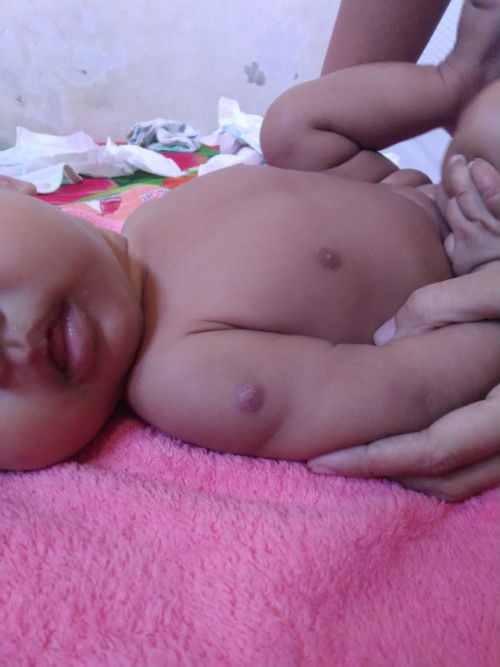 Bekas imunisasi bengkak