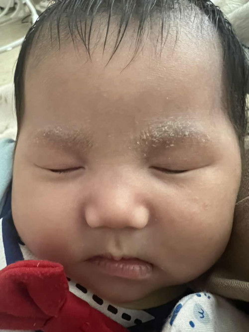 คิ้วลอก ตกสะเก็ด