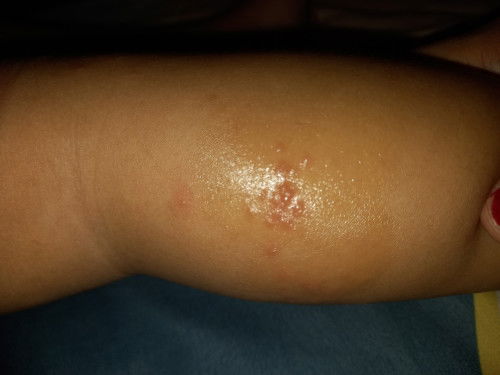 Bentol di kaki dan tangan