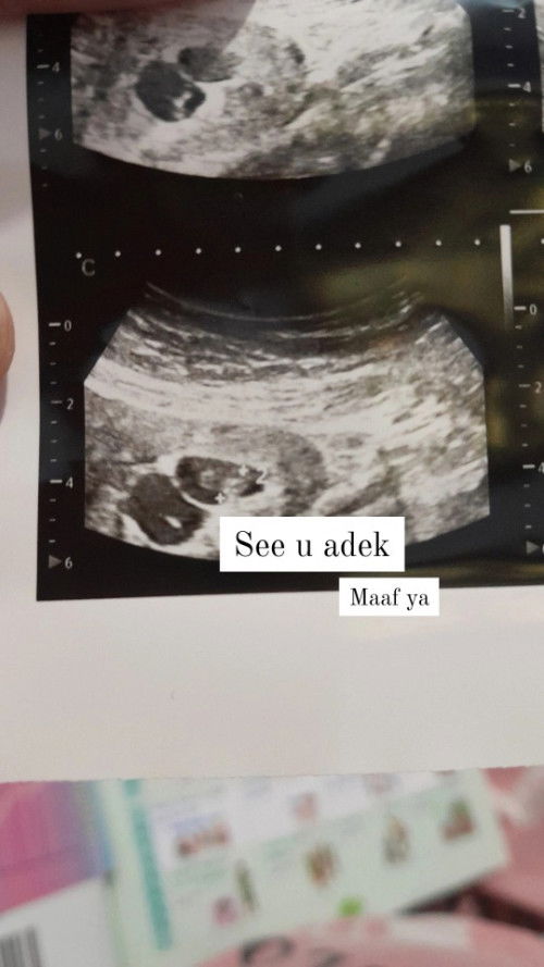 Pendarahan pasca vanishing twins syndrome