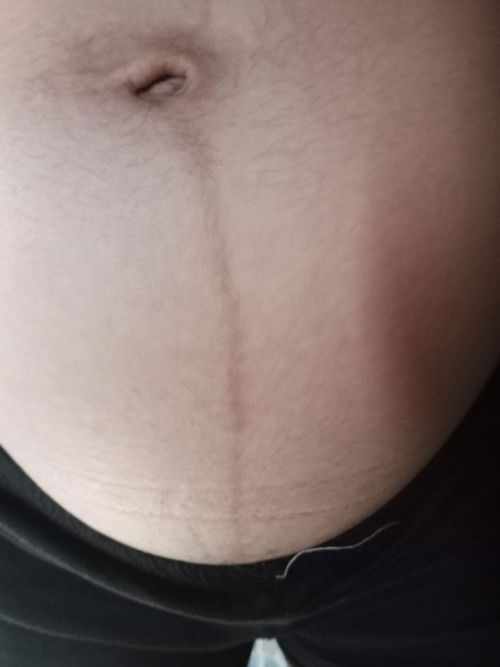 เส้นตรงกลางนี้จะหายไหมคะถ้าคลอด