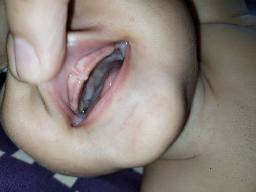 Hi po ask ko lang po nilagnat po sia nung nakaraan isang araw po tas panay ngatngat gigil na gigil