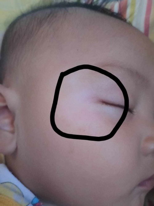 Puti puti sa mukha ni LO