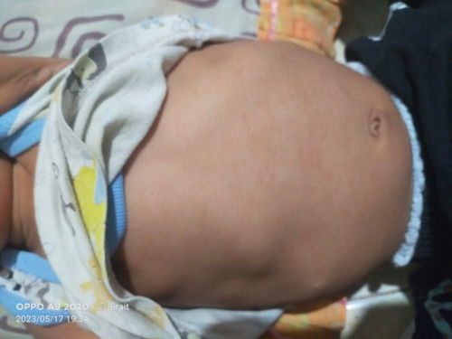 Tulang rusuk menonjol