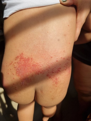 Ano po kaya magandang gamot sa rashes ni baby?