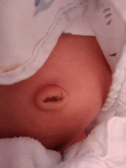 สะดือลูกหลุดแต่เป็นแบบนี้อันตรายมั้ยค่ะแม่ๆ#ขอบคุณสำหรับคำติบค้ะ