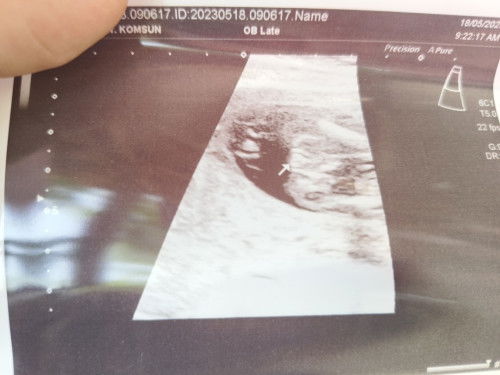 ผลอัลตร้าซาวด์ของลูก