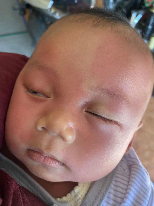 Ruam di seluruh badan