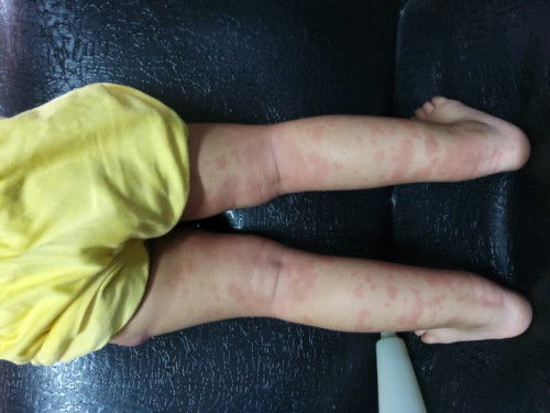 Skin rashes/ red patches on 2yr old