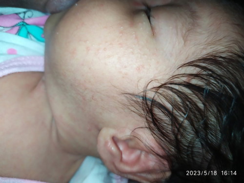 Baby acne home remedy?