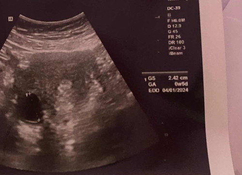 Normal gak bun usia 6w5d tp masih kelihatan kantungnya aja dan ukurannya udh 2.42cm