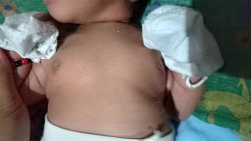 Bukol sa dede sa 12 days old babygirl