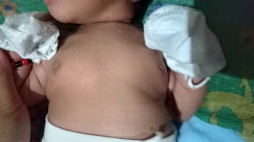 Bukol sa dede sa 12 days old babygirl