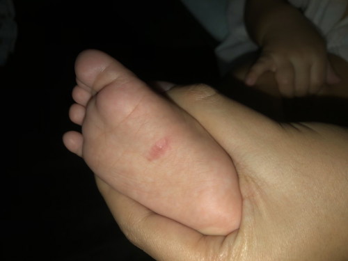 เวลาน้องโดนยุงกัด มดกัด ใช้อะไรลดรอยแดงคะข