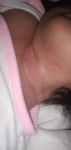 Normal rash?