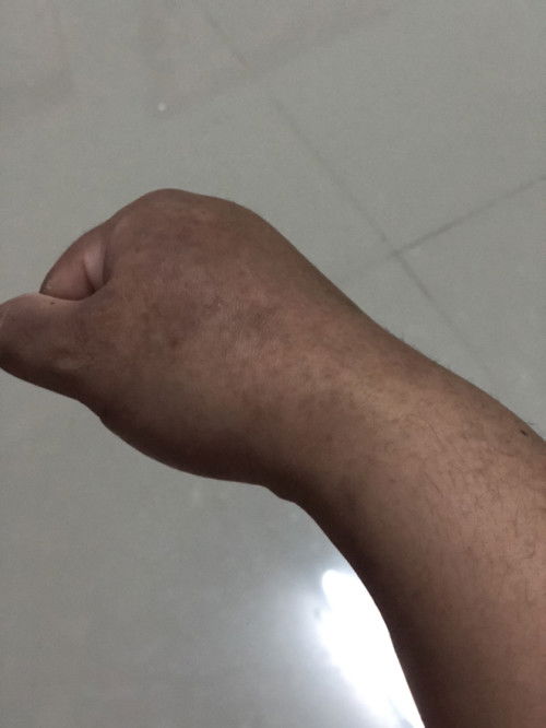 ของคุณแม่ท่านใหนเคยเป็นแบบนี้บางค่ะ แพ้ หรือเป็นปกติของคนท้อง17w