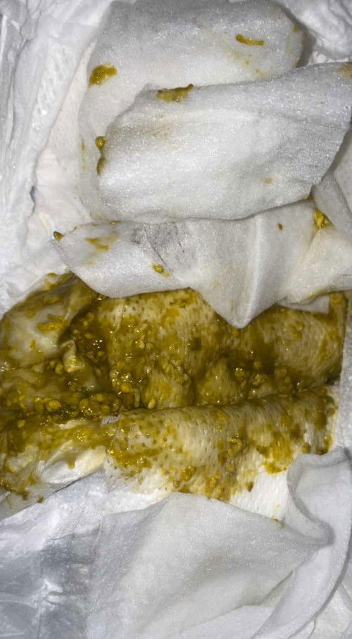 แบบนี้เรียกว่าท้องเสีย หรือถ่ายเหลวไหมคะ แล้วอารลำไส้อักเสบมีอาการยังไงบ้างคะแม่ๆ🥹🙏🏻