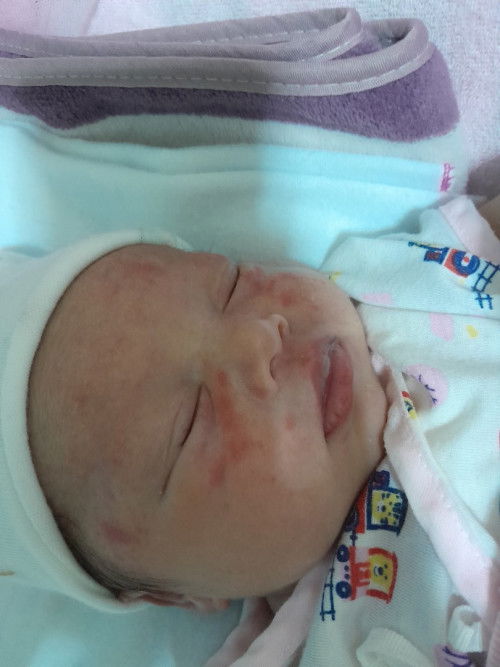 ผื่นแดงขึ้นบนใบหน้า ขึ้นผื่นแบบนี้ขอสอบถามคะปกติไหมคะ ดูแลรักษาเบื้องต้นยังไงดีคะ.