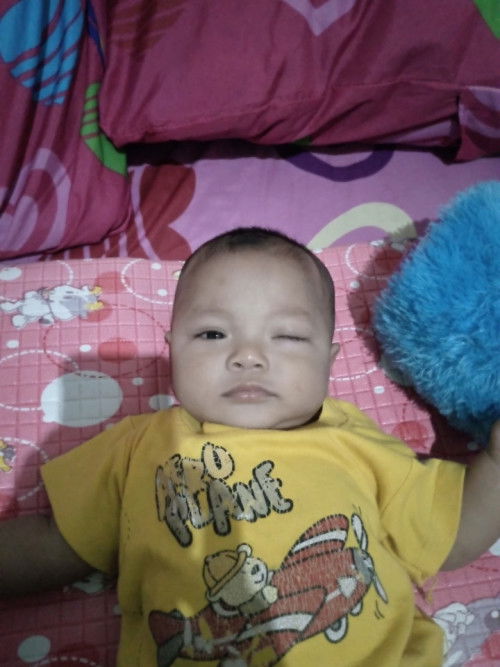 Ada yang tau ga rekomendasi obat sakit mata untuk bayi 5 bulan?