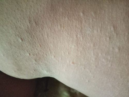 สอบถามหน่อยคะคันมากเป็นอาทิตย์ยังไม่หายคันแบบเกาจนแสบเลือดซึมหายคันแล้วก็ยุบปรกติแต่กำเริบทุกวัน