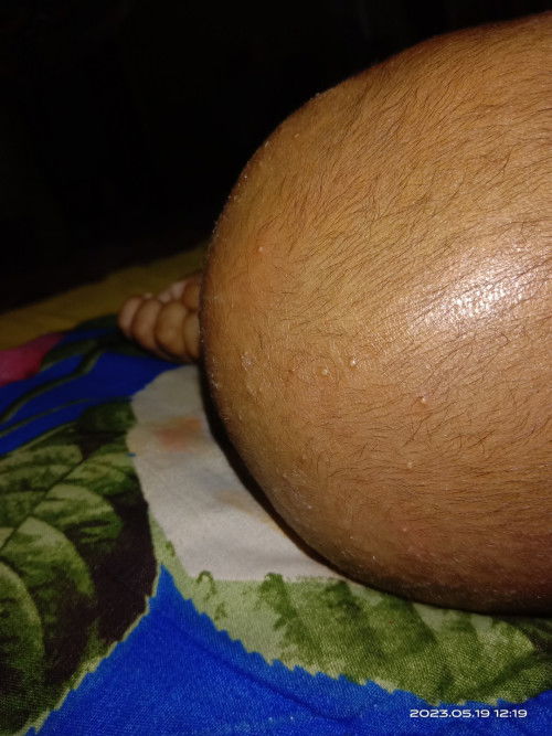 Bun ,mau tanya obt buat biang kringat di kepala bayi 2bulan apa ya bun ,udh tk kasih cussoncrm ttp